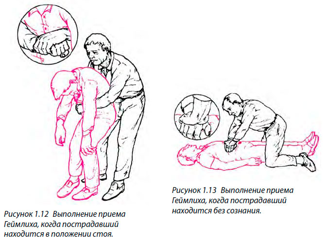 Выполнение приема Геймлиха, когда пострадавший находится в положении стоя