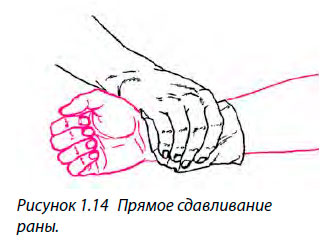 Прямое сдавливание раны