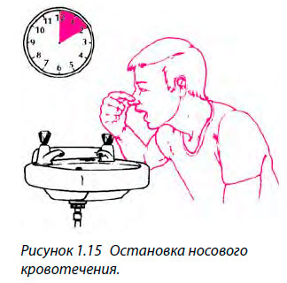 Остановка носового кровотечения