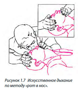 Искусственное дыхание по методу «рот в нос»