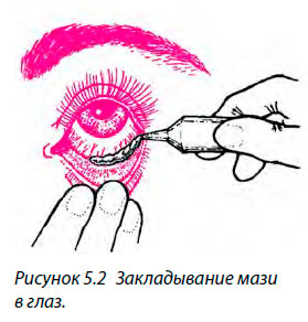 Закладывание мази в глаз