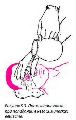 Промывание глаза при попадании в него химических
веществ