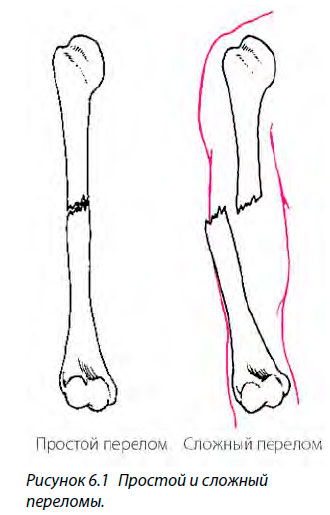 Простой и сложный переломы.
