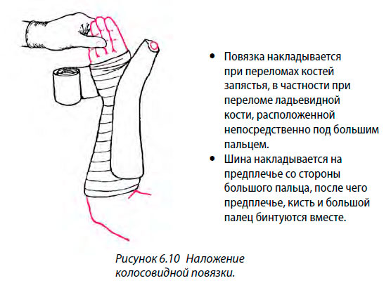 Наложение колосовидной повязки