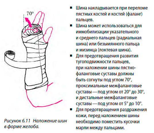 Наложение шины в форме желоба