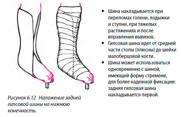 Наложение задней гипсовой шины на нижнюю
конечность