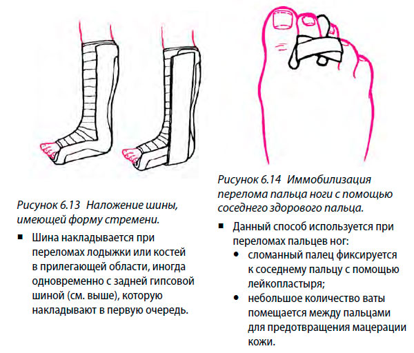 Наложение шины, имеющей форму стремени