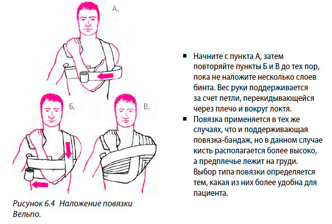 Наложение повязки Вельпо