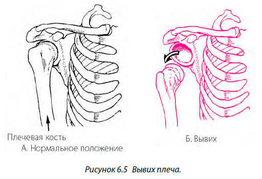 Вывих плеча