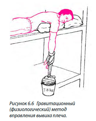 Гравитационный (физиологический) метод
вправления вывиха плеча