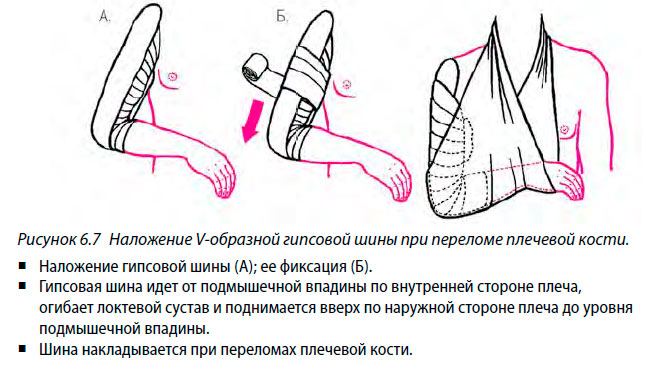 Наложение V-образной гипсовой шины при переломе плечевой кости