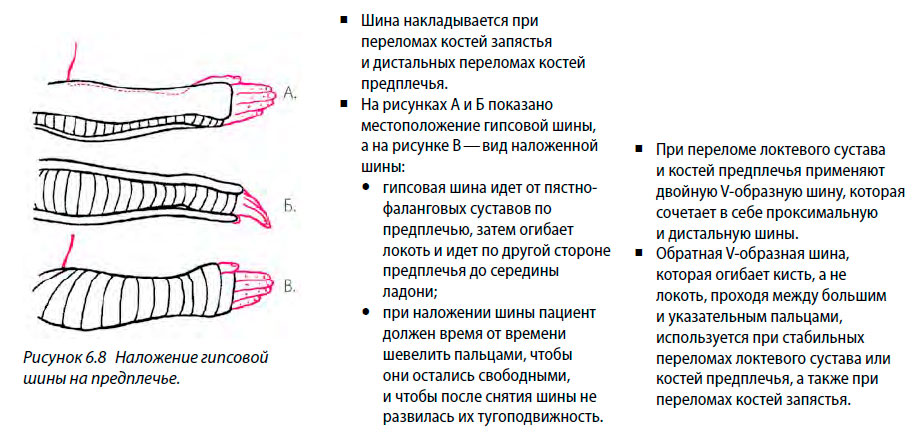 Наложение гипсовой шины на предплечье.
