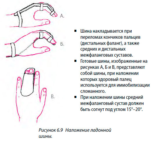 Наложение ладонной шины.