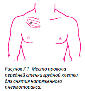 Место прокола передней стенки грудной клетки
для снятия напряженного пневмоторакса.