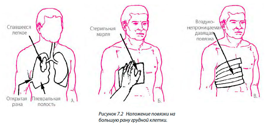 Наложение повязки на большую рану грудной клетки.