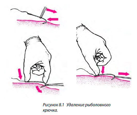 Удаление рыболовного крючка