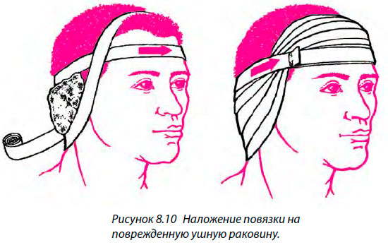 Наложение повязки на поврежденную ушную раковину.