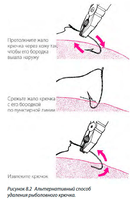 Альтернативный способ удаления рыболовного крючка