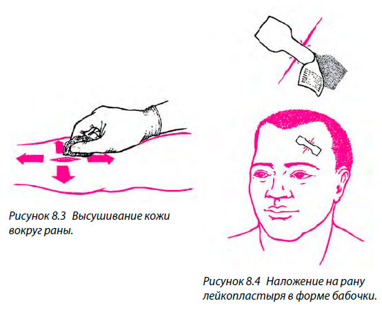 Наложение на рану лейкопластыря в форме бабочки