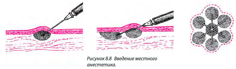 Введение местного анестетика