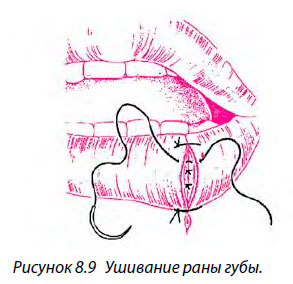 Ушивание раны губы