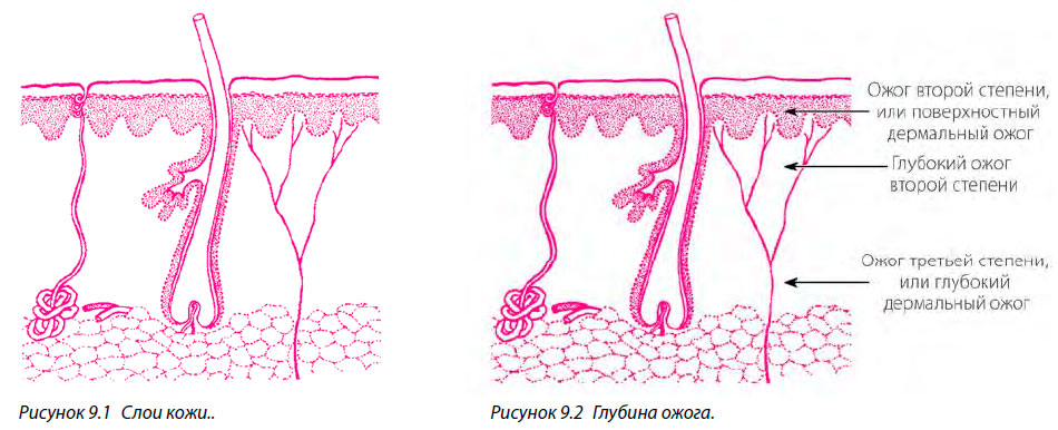 Слои кожи и Глубина ожога