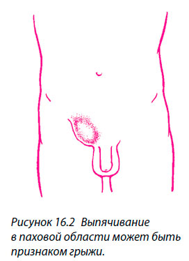 Выпячивание
в паховой области может быть признаком грыжи