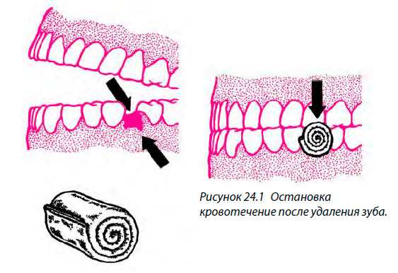 Остановка кровотечение после удаления зуба