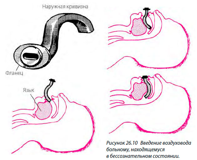 Введение воздуховода
больному, находящемуся в бессознательном состоянии