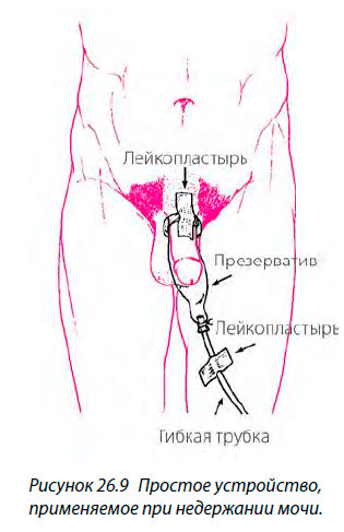 Простое устройство,
применяемое при недержании мочи.