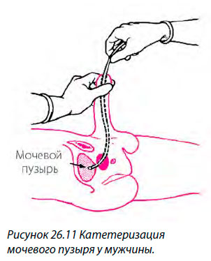 Катетеризация мочевого пузыря у мужчины