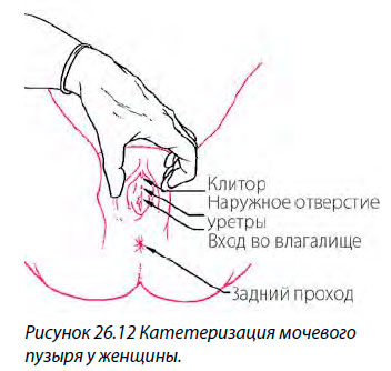 Катетеризация мочевого
пузыря у женщины
