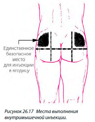 Места выполнения
внутримышечной инъекции.