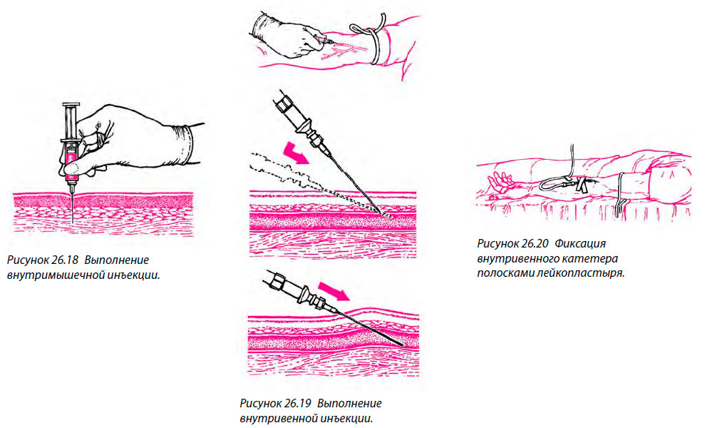 Фиксация внутривенного катетера
полосками лейкопластыря.