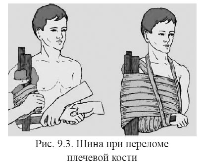 Шина при переломе плечевой кости